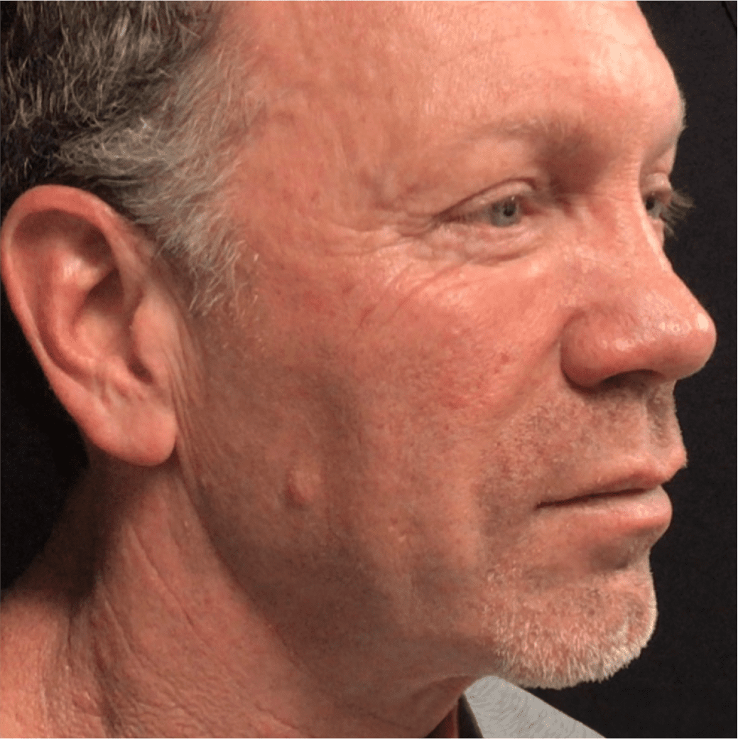 Man face after dermatology treatment
