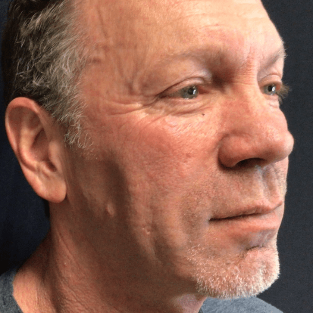 Man face before dermatology treatment