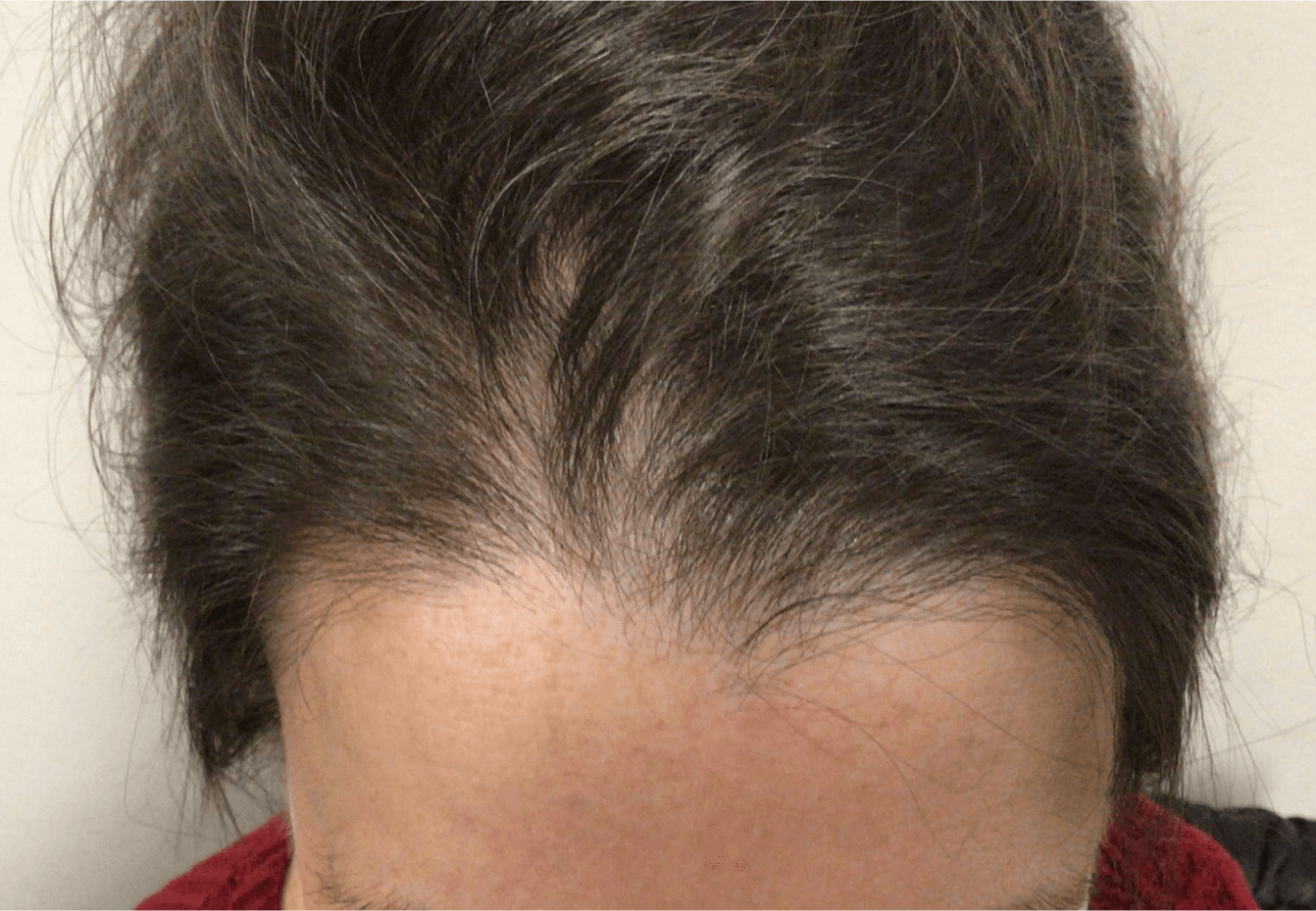Hair after dermatology treatment