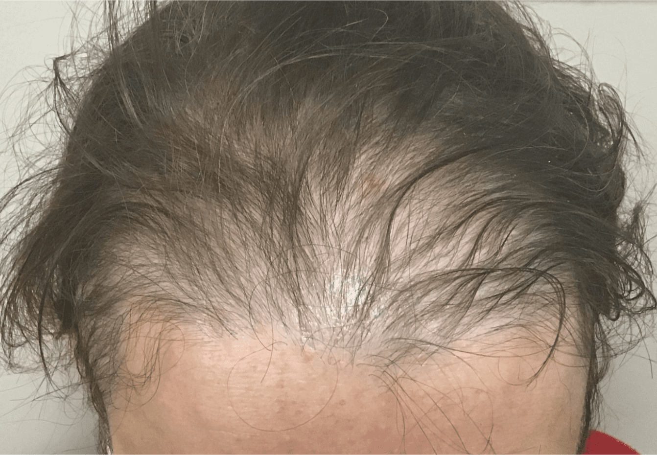 Hair before dermatology treatment