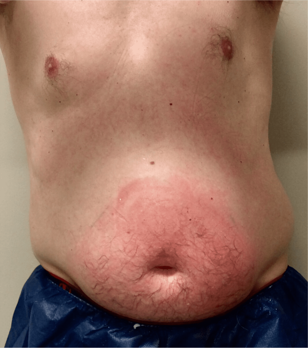 Man stomach before dermatology treatment