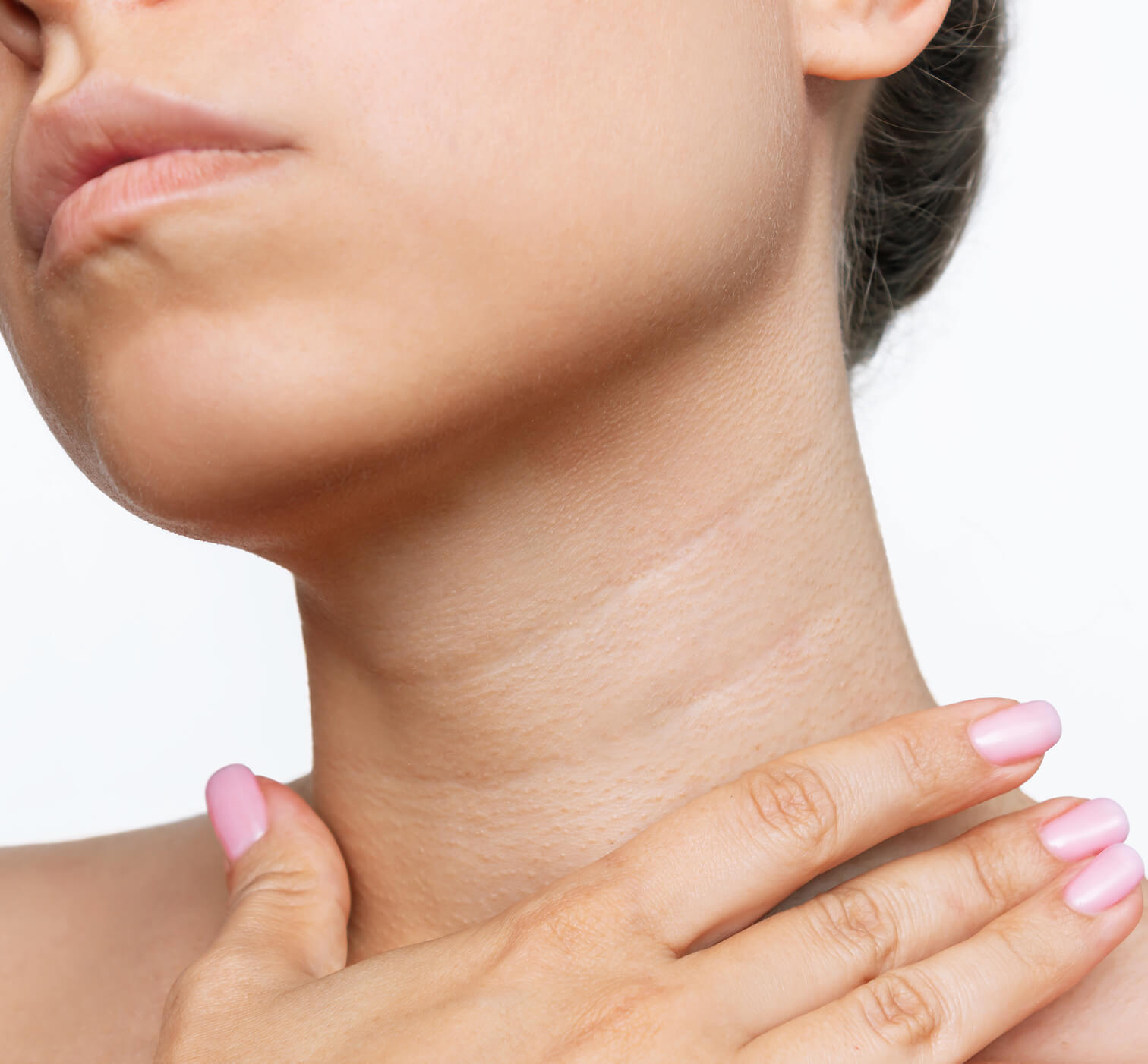 Close-up of the neck and jawline showing horizontal neck lines that PLLA collagen therapy can help rejuvenate.