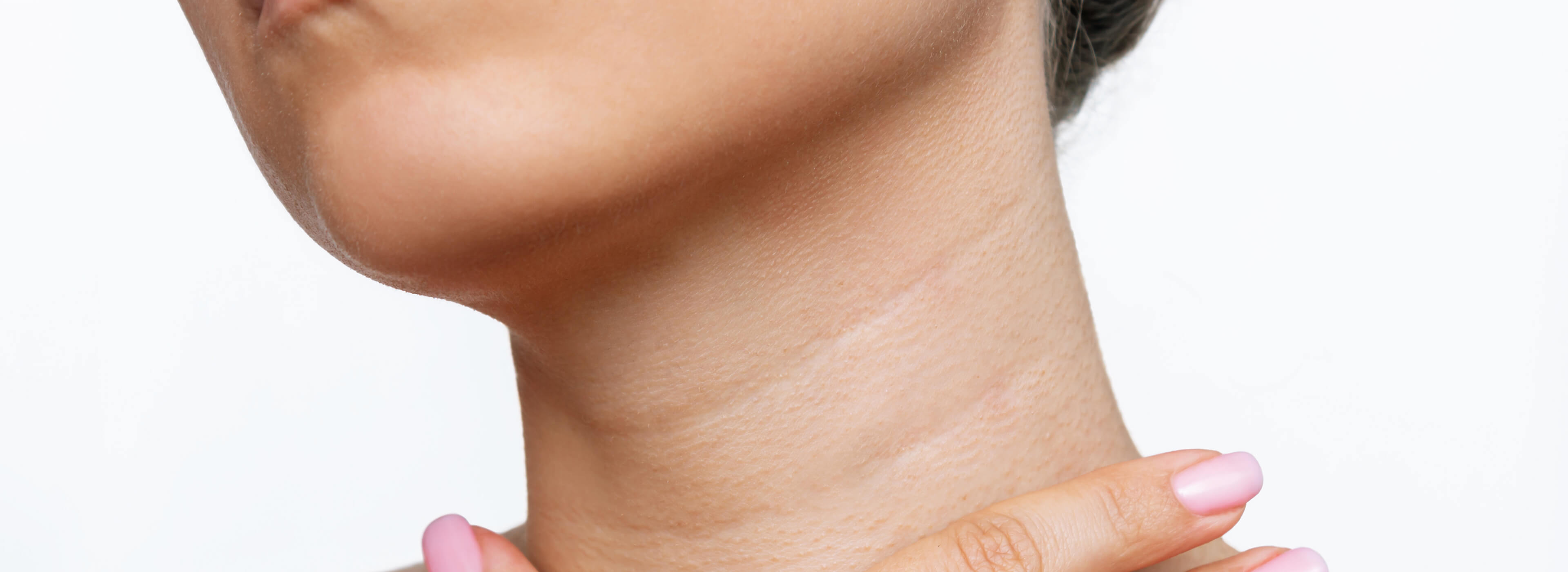 Close-up of the neck and jawline showing horizontal neck lines that PLLA collagen therapy can help rejuvenate.