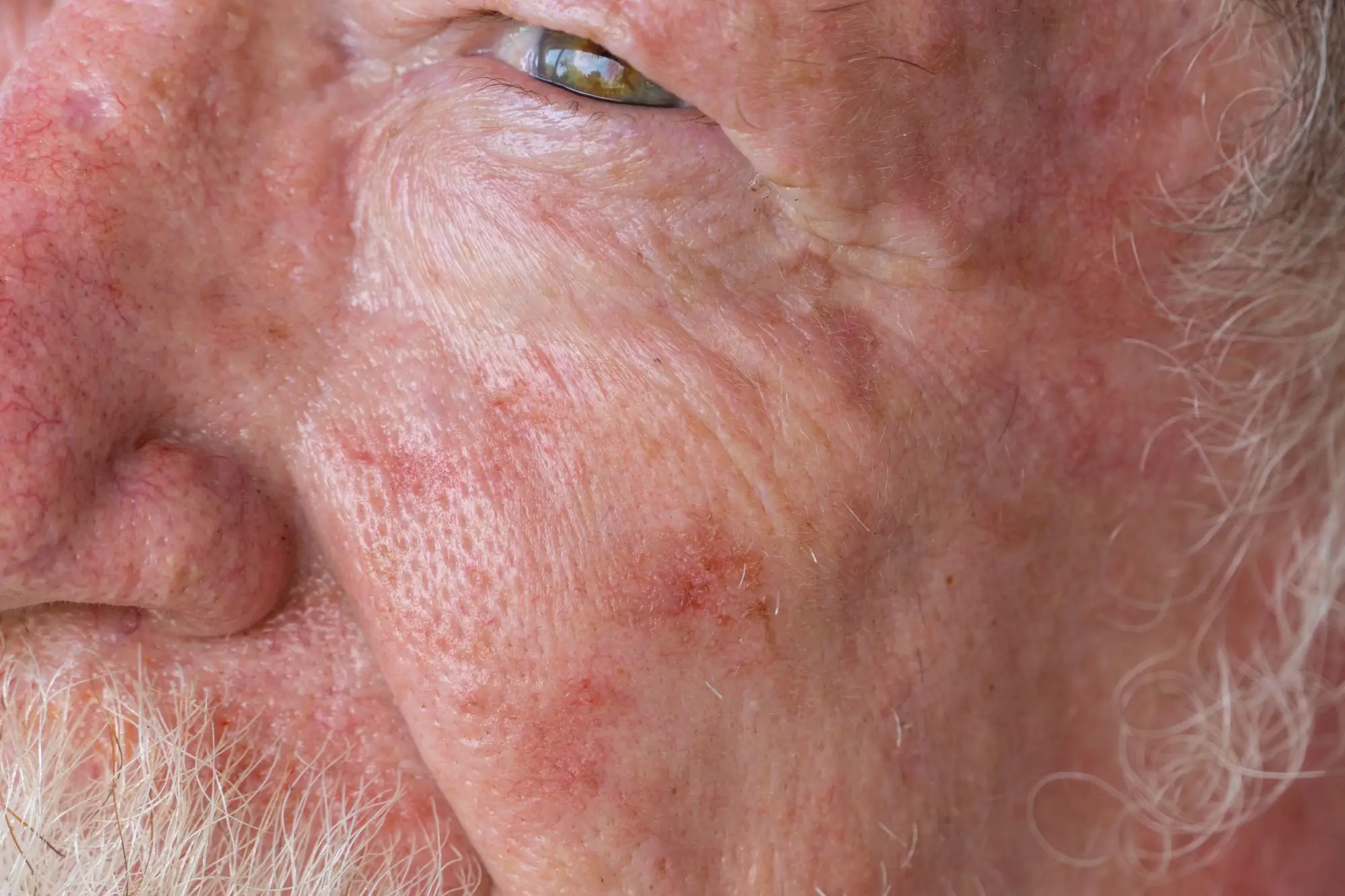 Close-up of elderly man's cheek with sun-damaged skin, visible redness, age spots, and broken capillaries.
