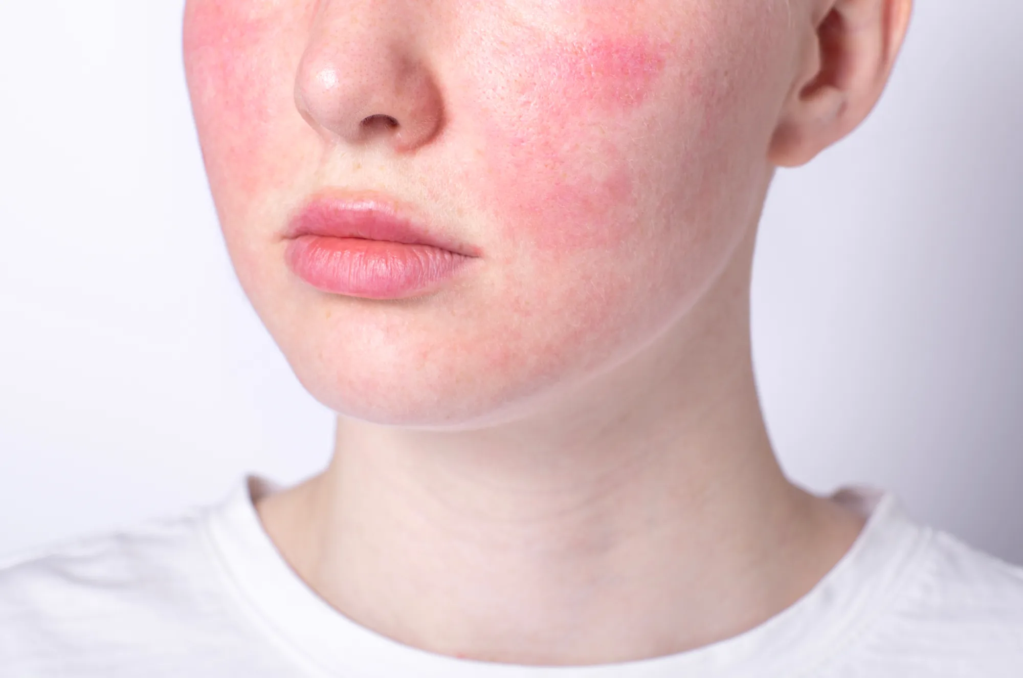 Close-up of woman's face with facial redness and inflammation on cheeks, commonly associated with rosacea.