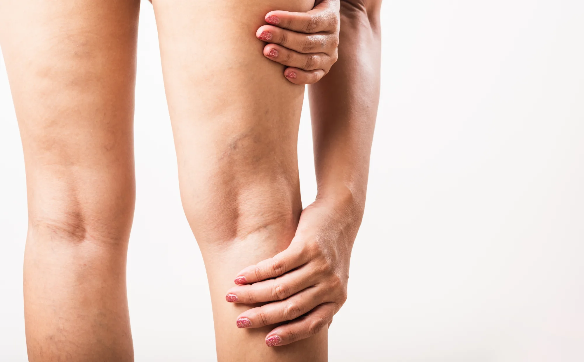 Woman holding leg with visible spider veins and varicose veins on thighs and calves against white background.
