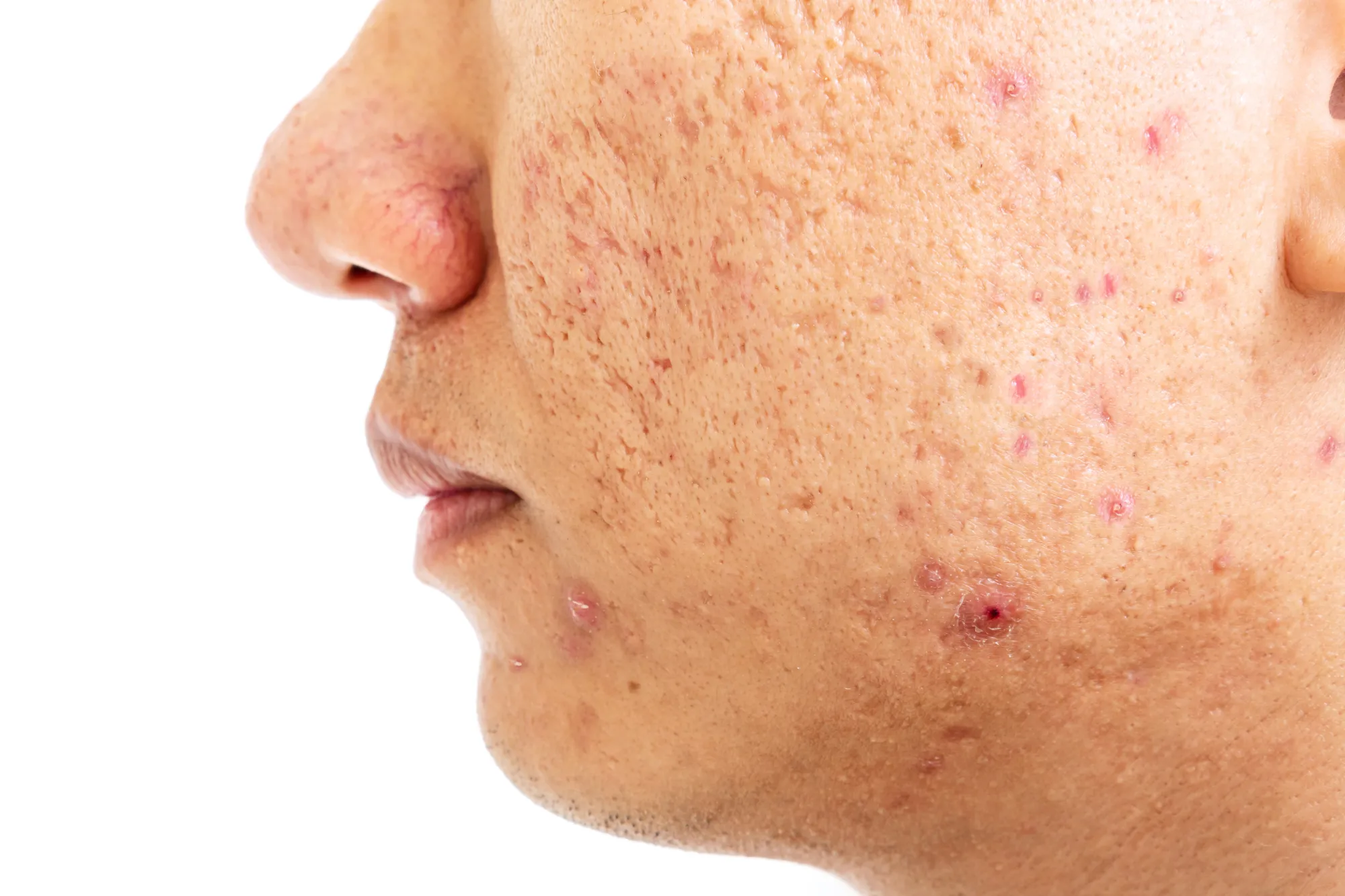 Close-up of male face with inflamed acne, acne scars, and enlarged pores on cheek and chin area.