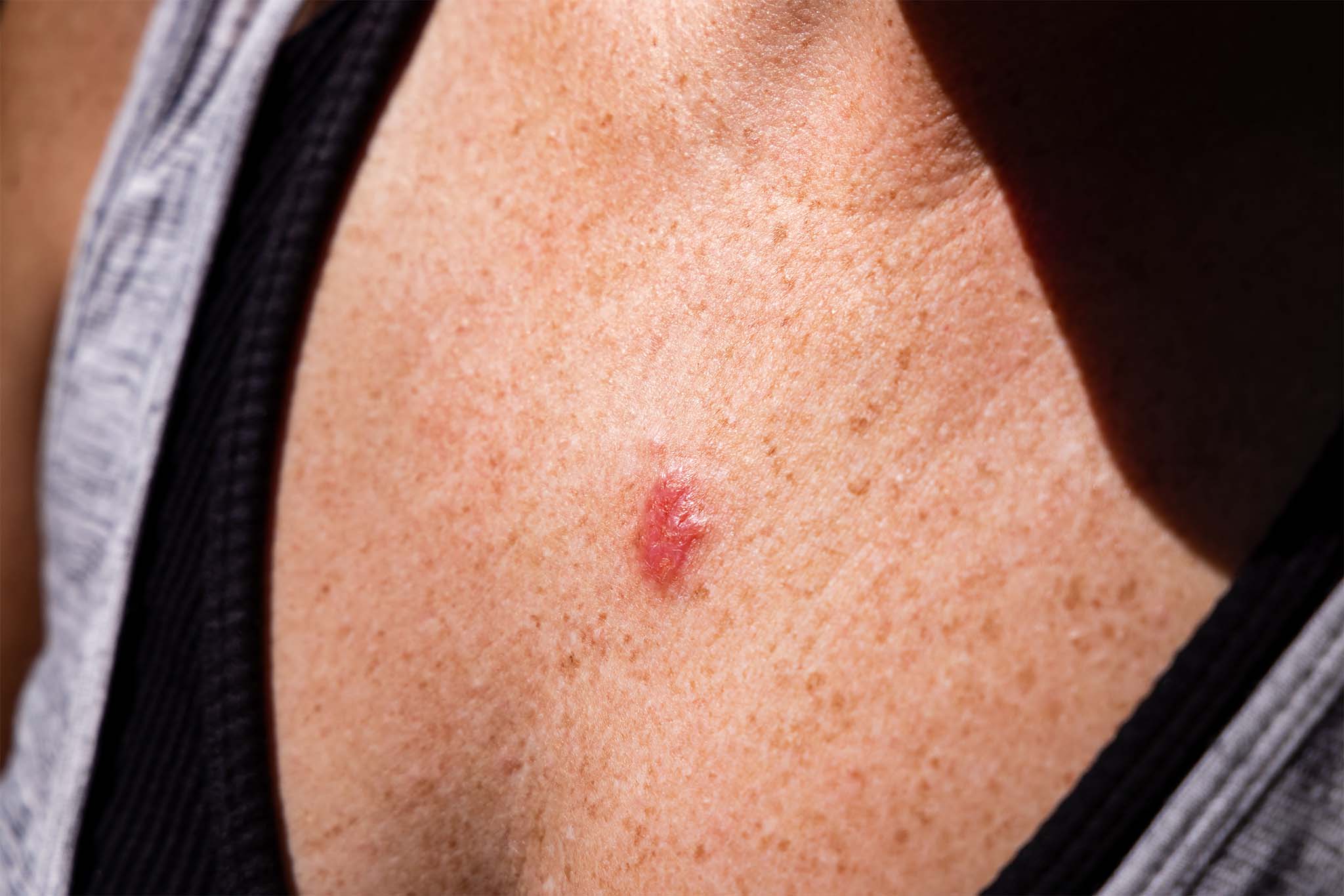 Close-up of a skin lesion on the chest, indicative of potential skin cancer.