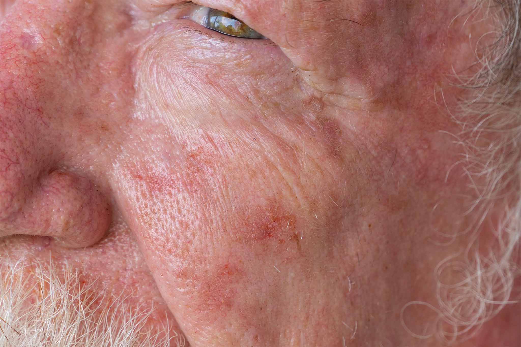 Close-up of an elderly man's cheek with actinic keratoses, showing rough, scaly skin patches caused by sun exposure.